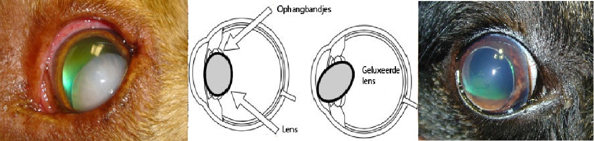 Primaire Lens Luxatie